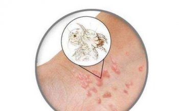 疥疮容易复发是怎么回事