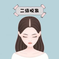 雄激素性脱发是怎么发展的